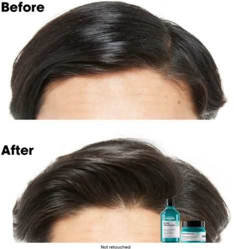 Loreal Scalp Advanced 2in1 mélytisztító sampon és pakolás zsíros hajra, 250 ml